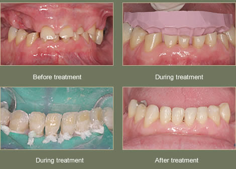 Composite Bonding Case 2