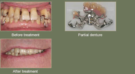 Partial Dentures